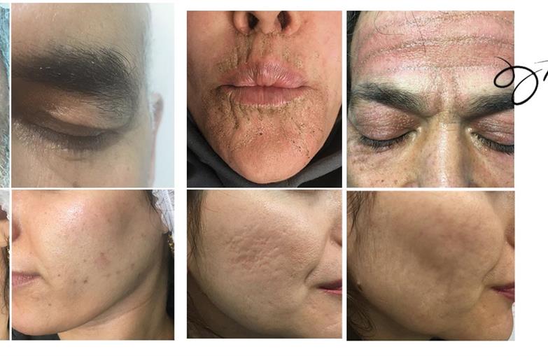 پلاسما تراپی یا پلاسماجت PLASMA THERAPY چیست؟و پلاسدرما PLASDERMA چه کاربردی دارد؟